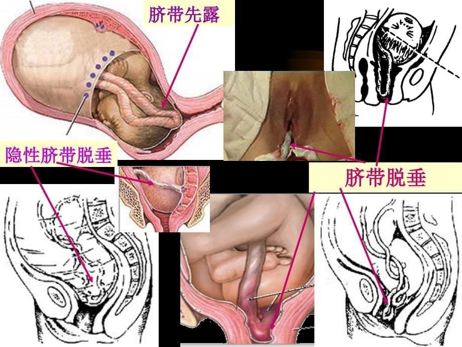 脐带脱垂课件_第5页