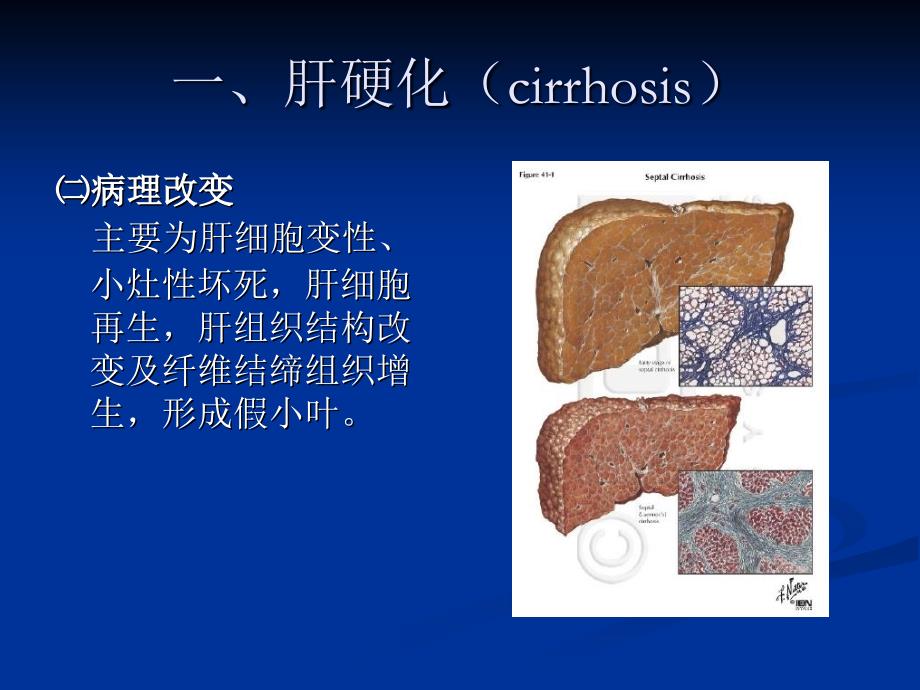 《肝脏弥漫性疾病》PPT课件_第4页