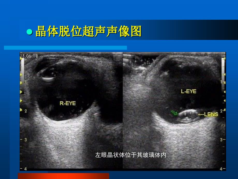 眼部常见病的超声诊断第二部分_第3页