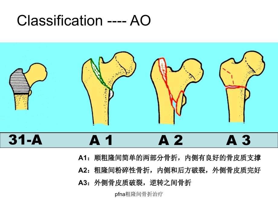 pfna粗隆间骨折治疗课件_第5页