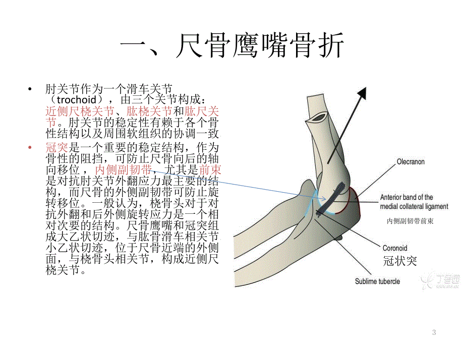 尺骨近端骨折ppt课件_第3页