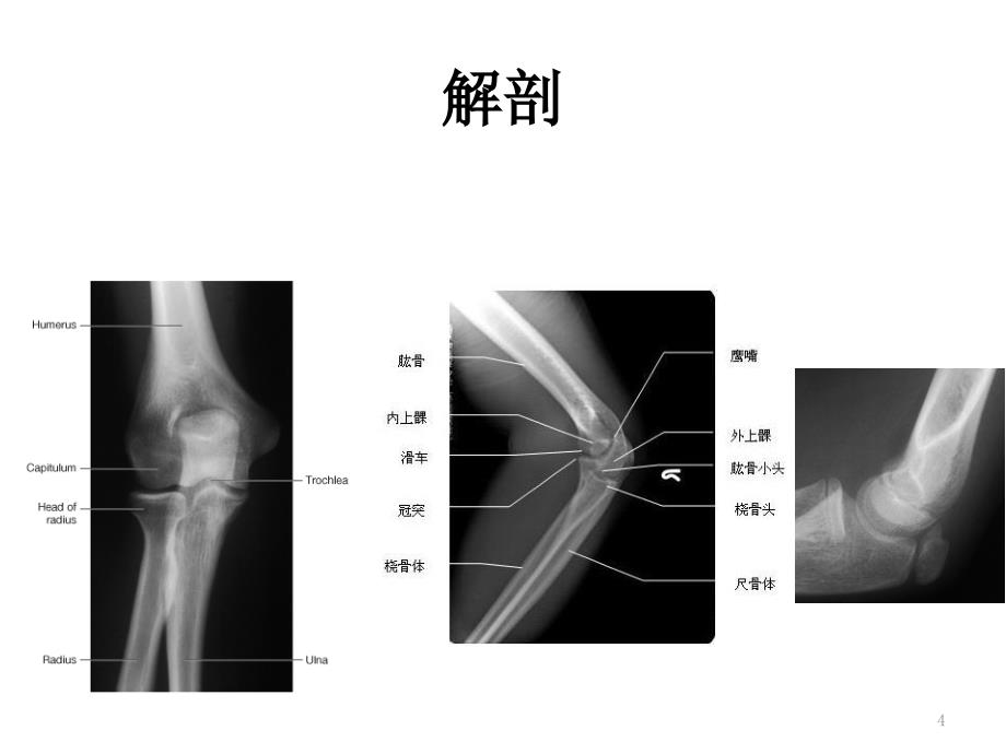 尺骨近端骨折ppt课件_第4页