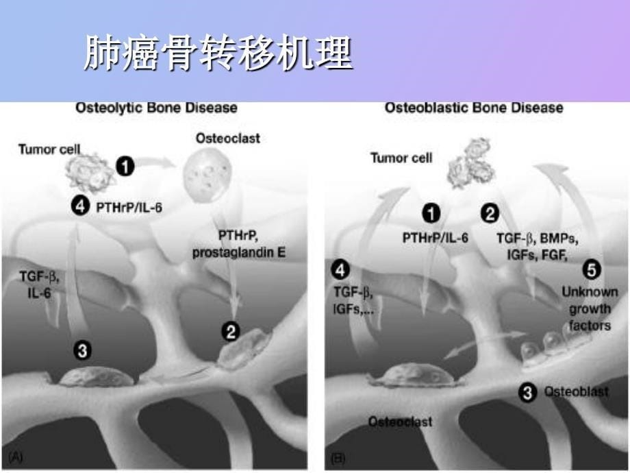 肺癌骨转移治疗_第5页