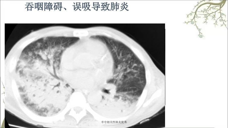 卒中相关性肺炎优秀_第5页