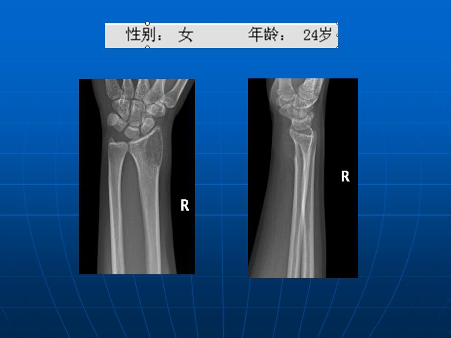 长骨偏心膨胀性病变诊断ppt课件_第2页