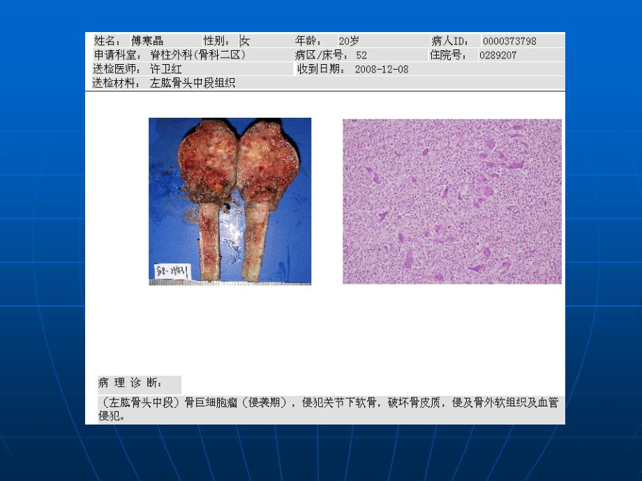 长骨偏心膨胀性病变诊断ppt课件_第3页