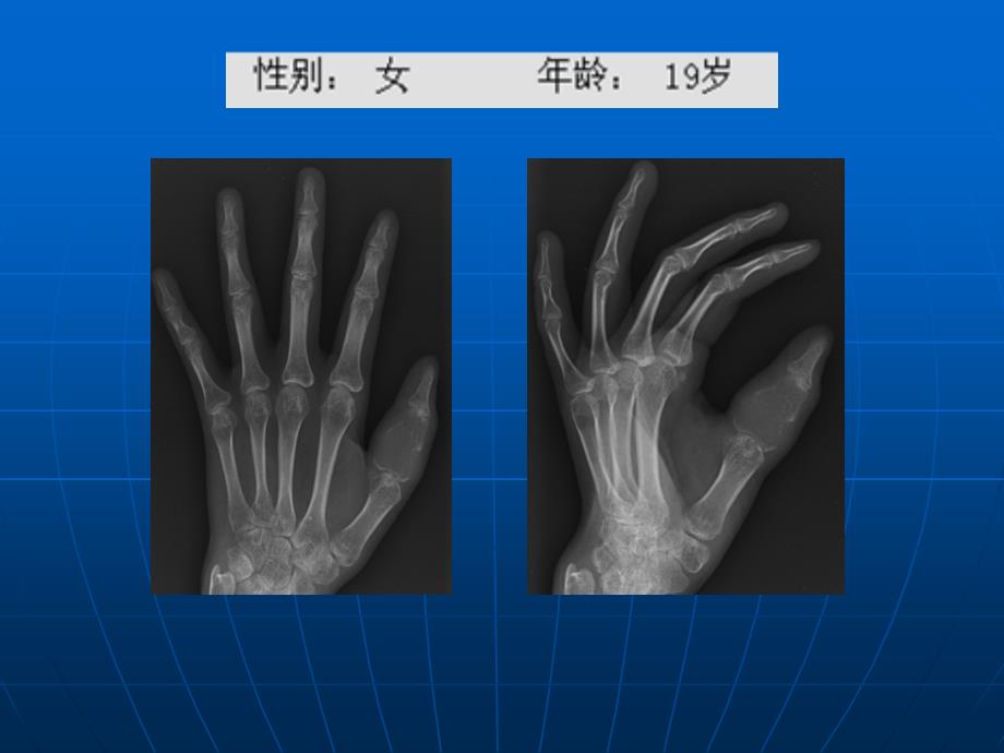 长骨偏心膨胀性病变诊断ppt课件_第4页