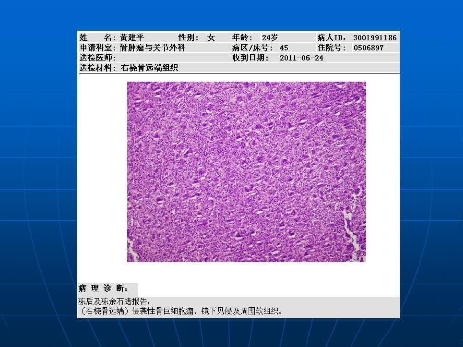 长骨偏心膨胀性病变诊断ppt课件_第5页