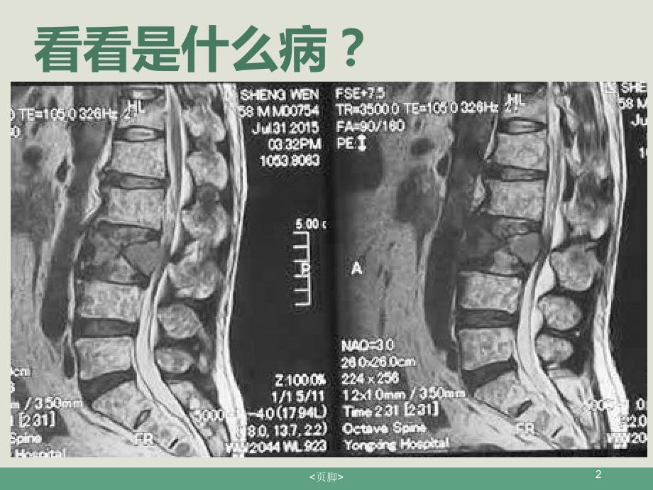 脊柱骨髓瘤PPT课件_第2页