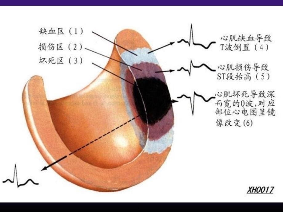 心肌梗死的课件_第5页