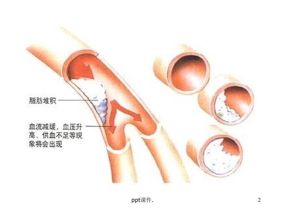 关注高血脂高血脂ppt课件_第2页