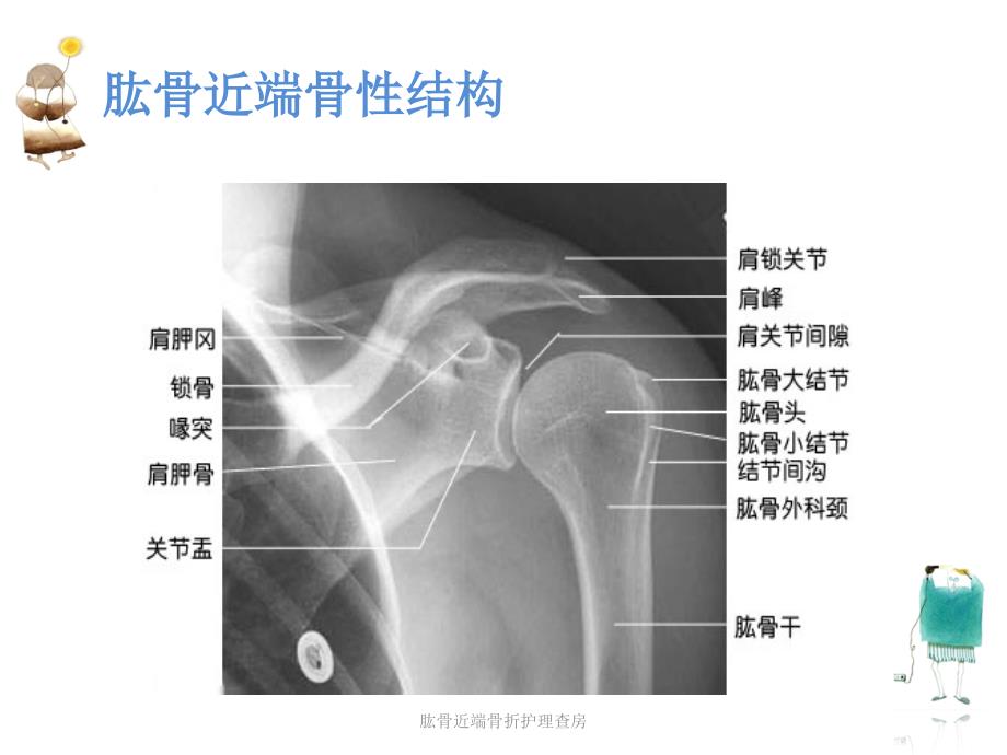 肱骨近端骨折护理查房课件_第3页