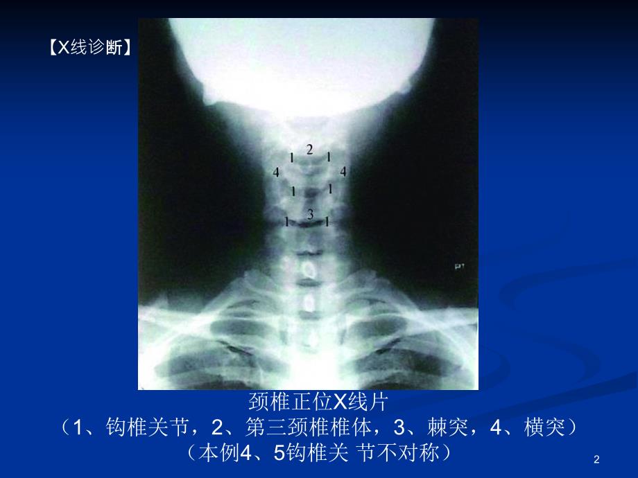 《整脊影像学诊断》PPT课件_第2页