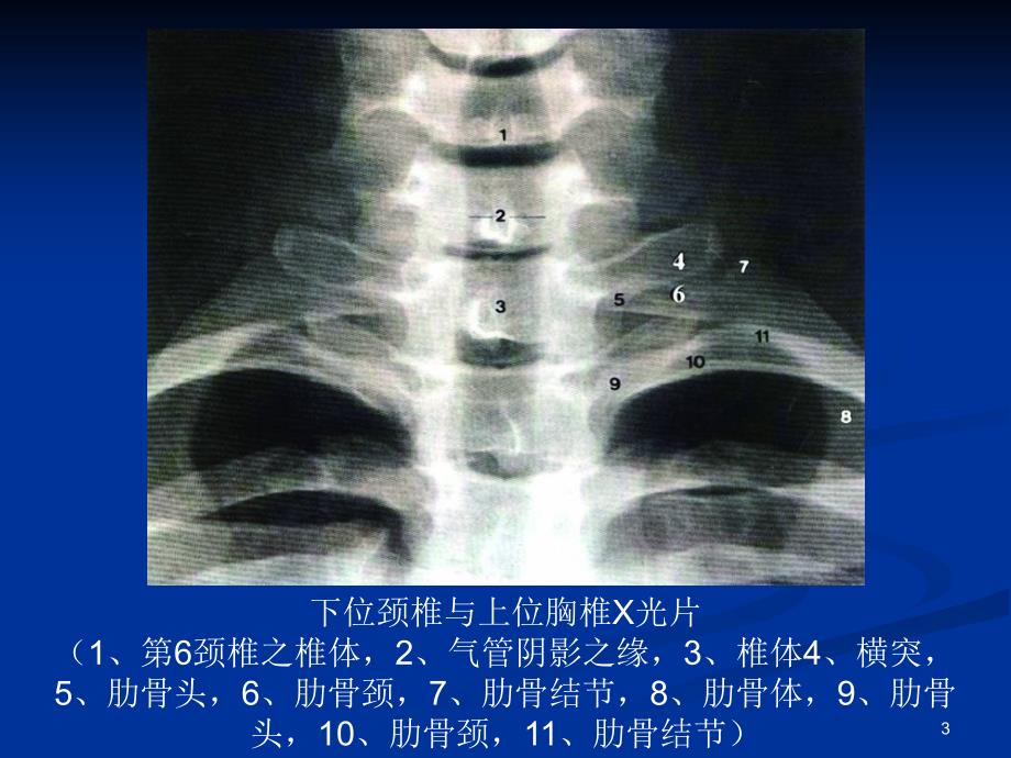 《整脊影像学诊断》PPT课件_第3页