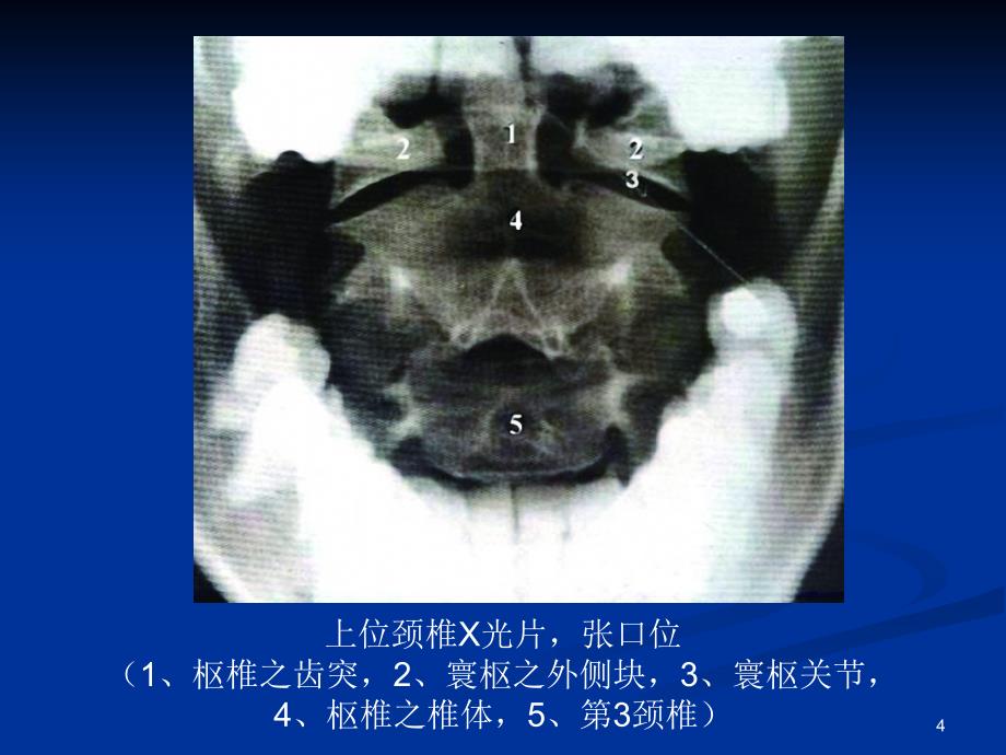 《整脊影像学诊断》PPT课件_第4页