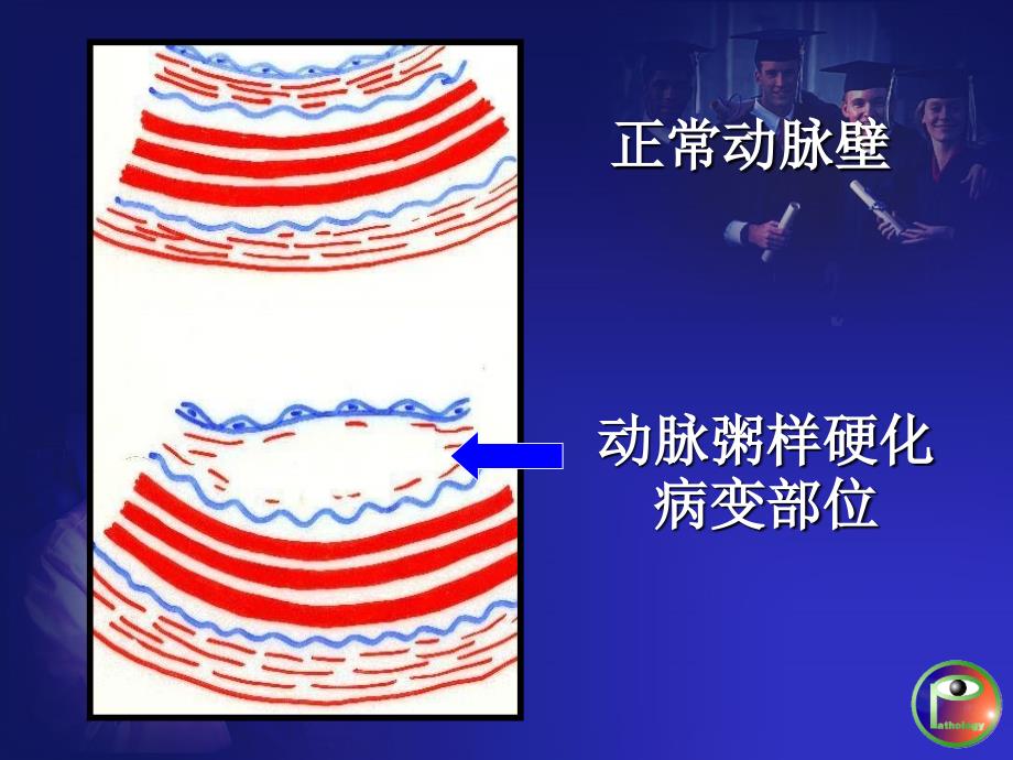 动脉粥样硬化、冠心病_第4页