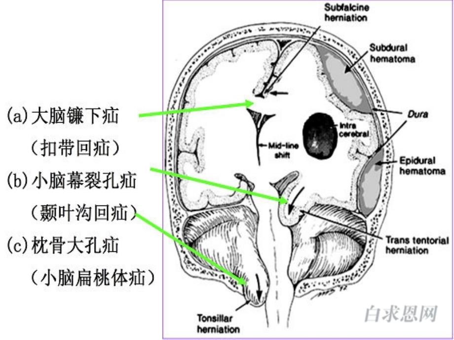 脑疝的临床表现及.ppt_第3页