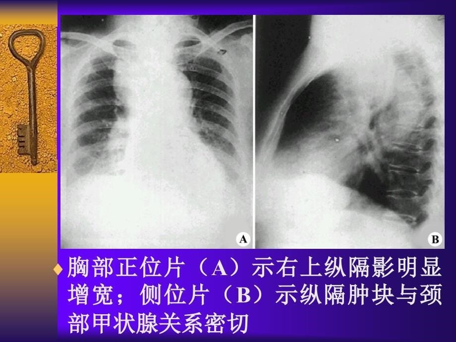 《纵隔疾病影像表现》PPT课件_第5页