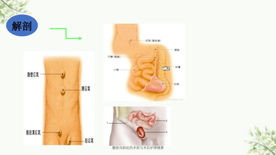 腹股沟斜疝的术前与术后护理精要课件_第4页