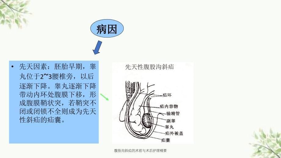 腹股沟斜疝的术前与术后护理精要课件_第5页