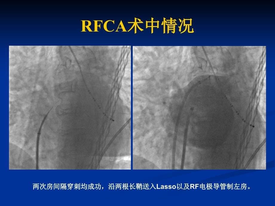 疑难病例crt失败病例杨东辉_第5页