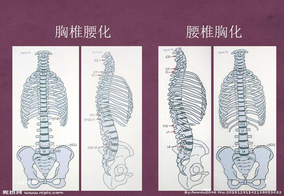 脊柱侧弯基础知识医学课件_第4页