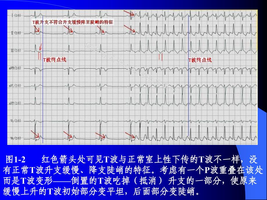 P波的识别与相关病例讨论之一PPT课件_第4页