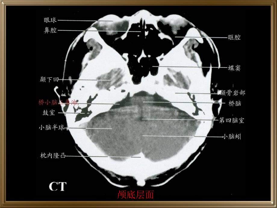 中枢神经系统断层影像_第4页