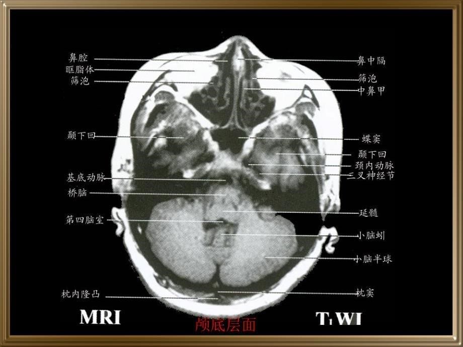 中枢神经系统断层影像_第5页