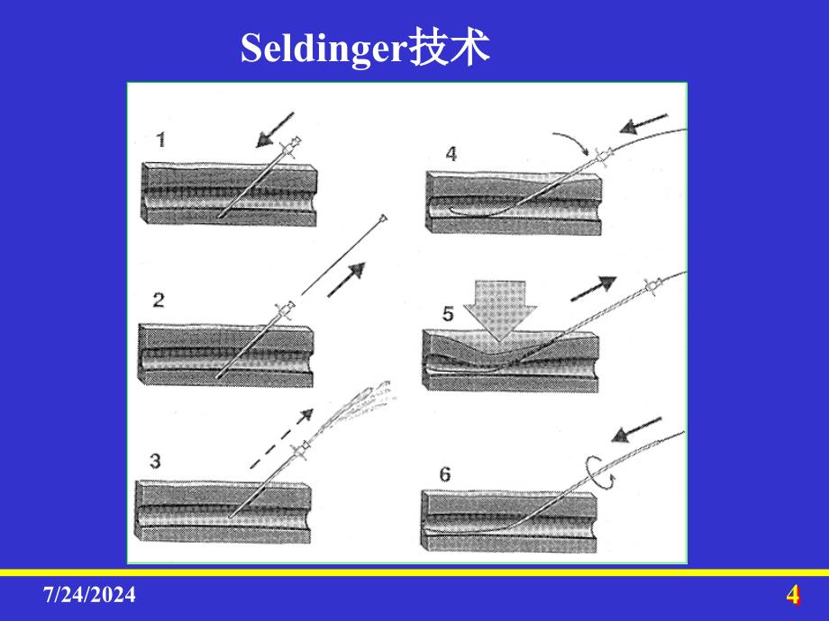 第五章--介入放射学总论讲述课件_第4页