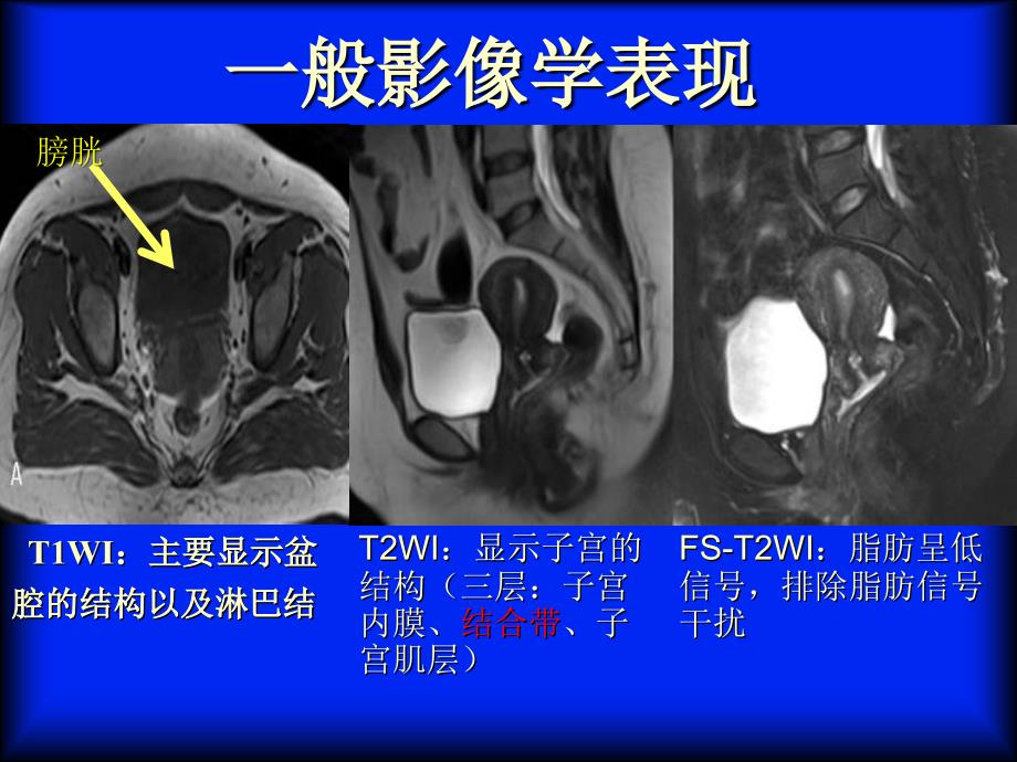 子宫腺肌症的MRI表现_第3页