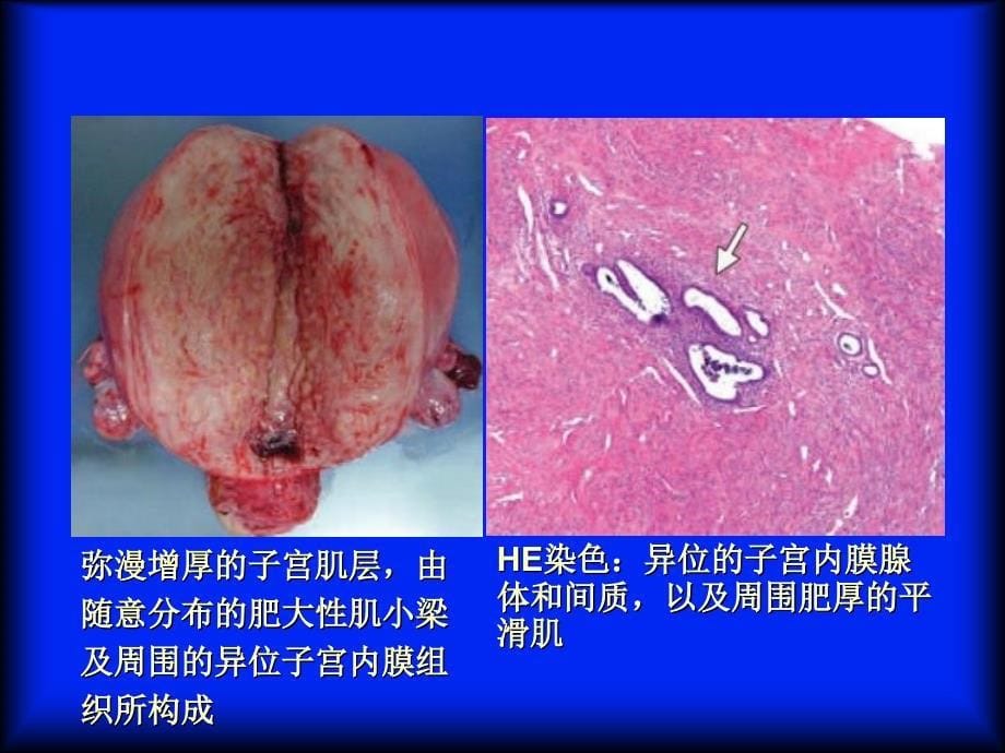 子宫腺肌症的MRI表现_第5页