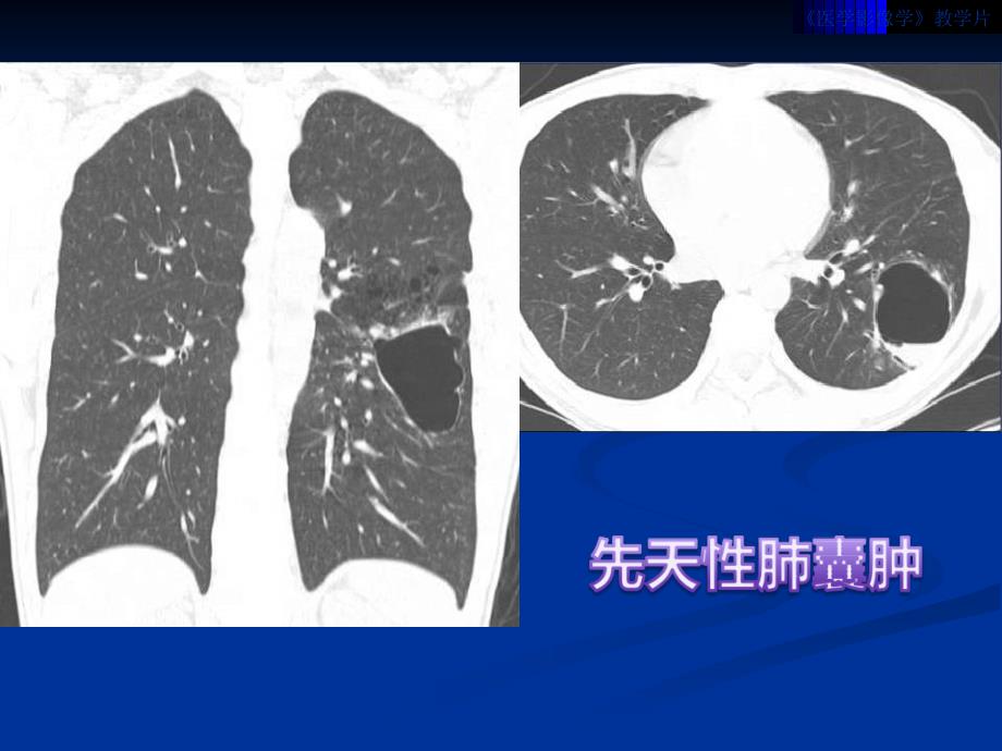 呼吸系统影像教学片三_第3页