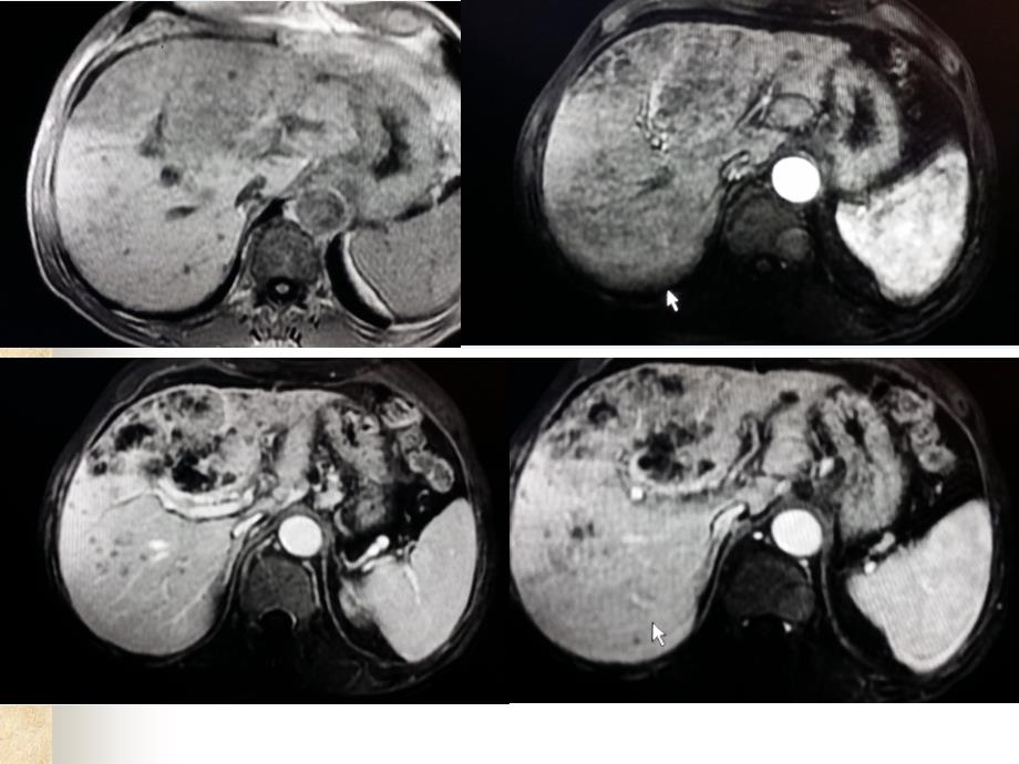 肝内胆管细胞癌 (武科大)图文并茂课件_第4页