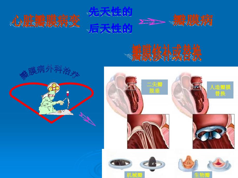 心脏瓣膜病围手术期护理_第4页