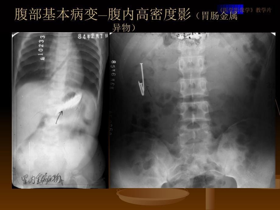 消化系统的影像诊断全套温医医学影像学课件_第5页