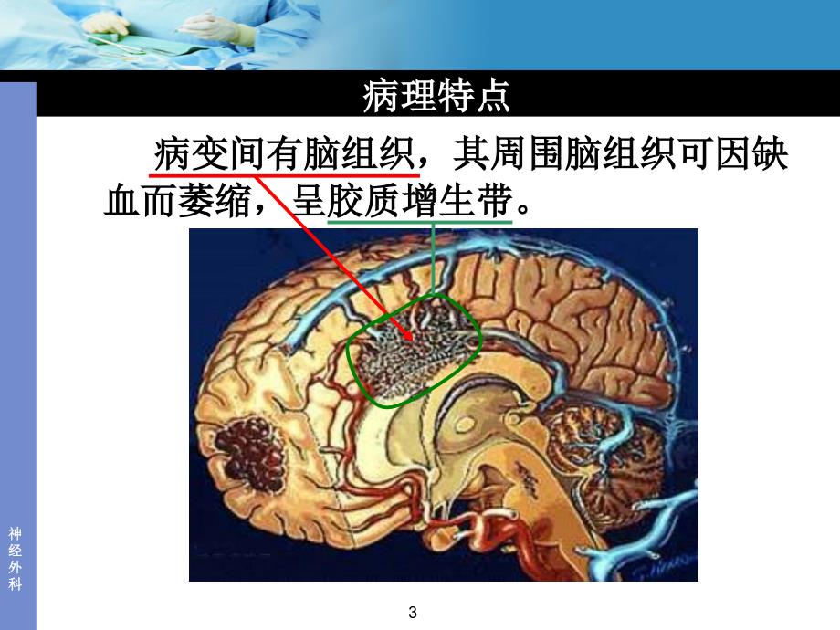 动静脉畸形AVMppt课件_第3页