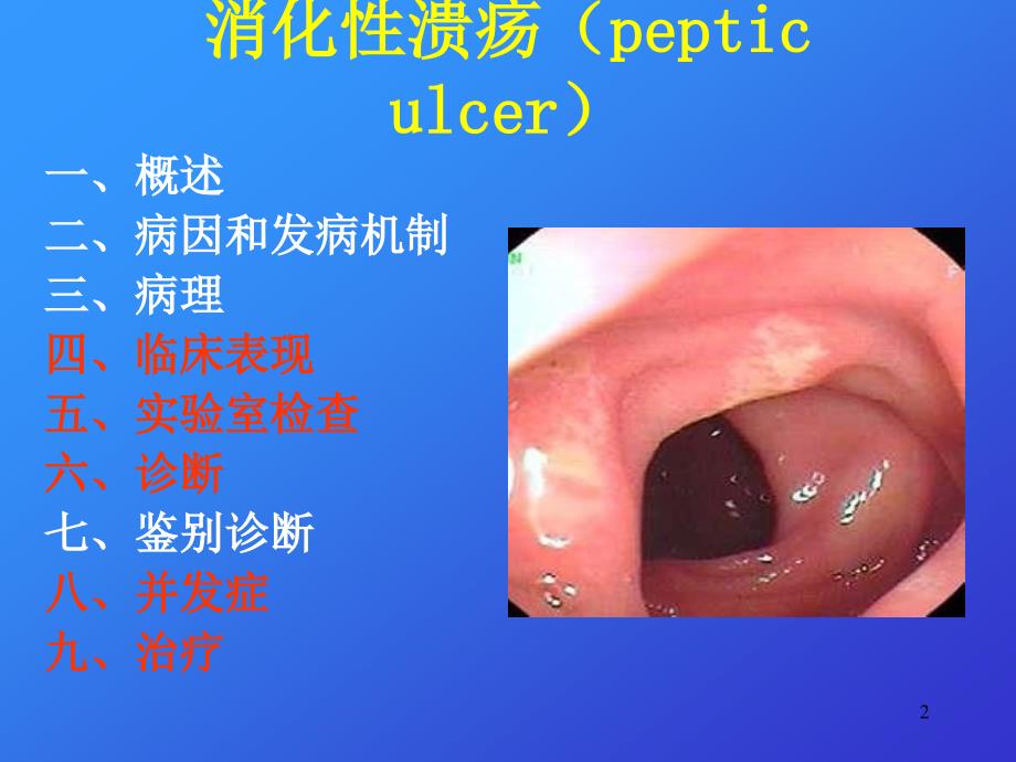 消化性溃疡ppt课件_第2页