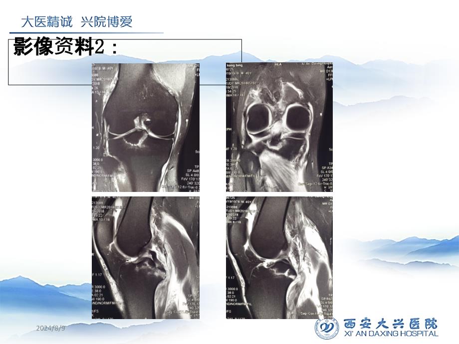 后交叉韧带胫骨止点撕脱骨折_第4页