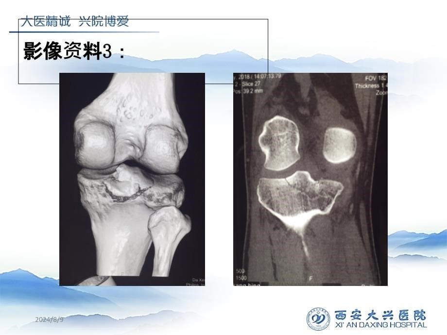 后交叉韧带胫骨止点撕脱骨折_第5页