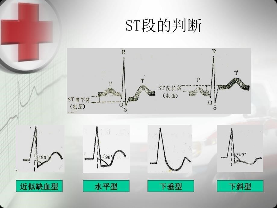 常见心电图的识别_第5页