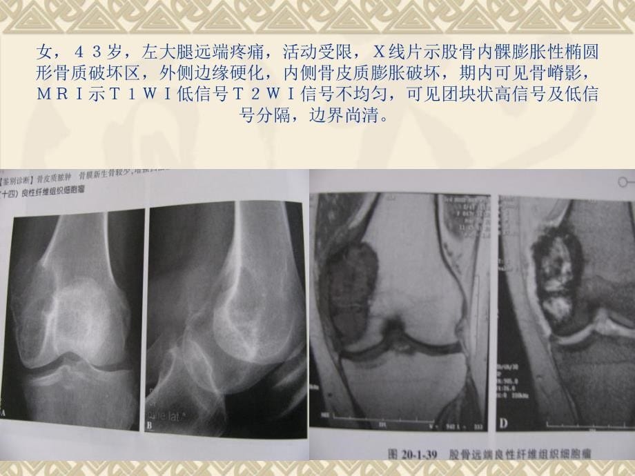 骨良性纤维组织细胞瘤诊断与鉴别_第5页