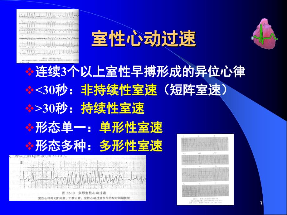 室速心电图PPT精选文档_第3页