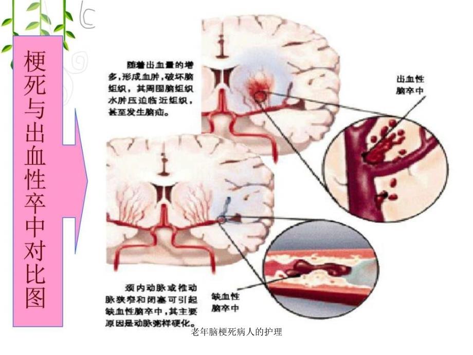 老年脑梗死病人的护理课件_第4页