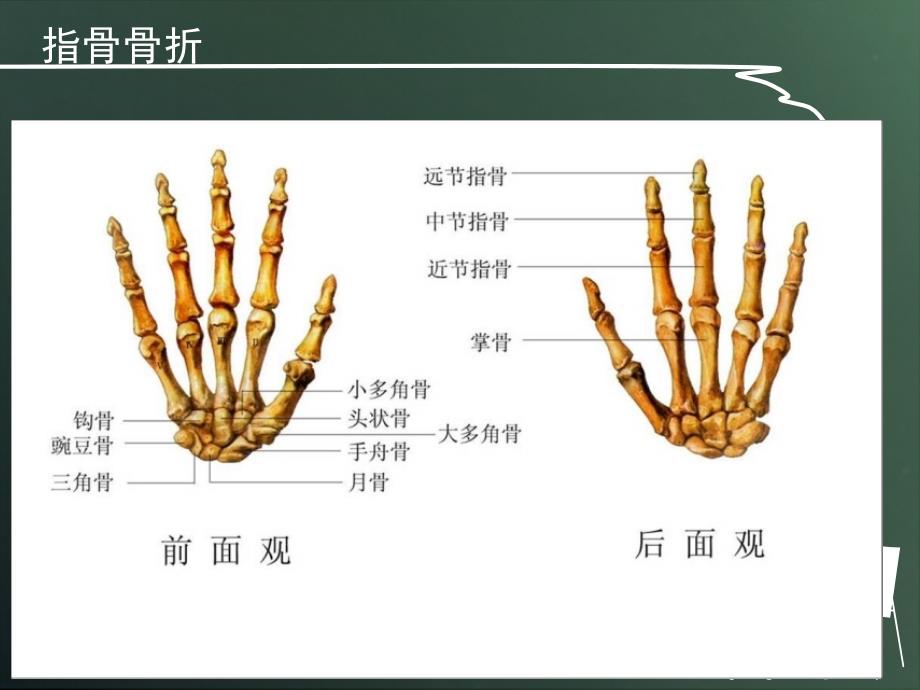 优质医学指骨骨折的护理_第3页