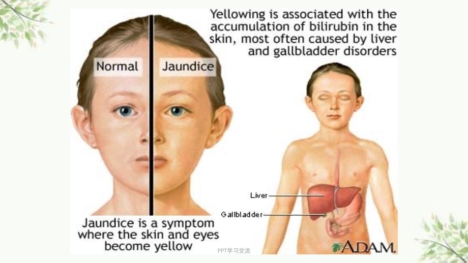 黄疸医学ppt课件_第2页