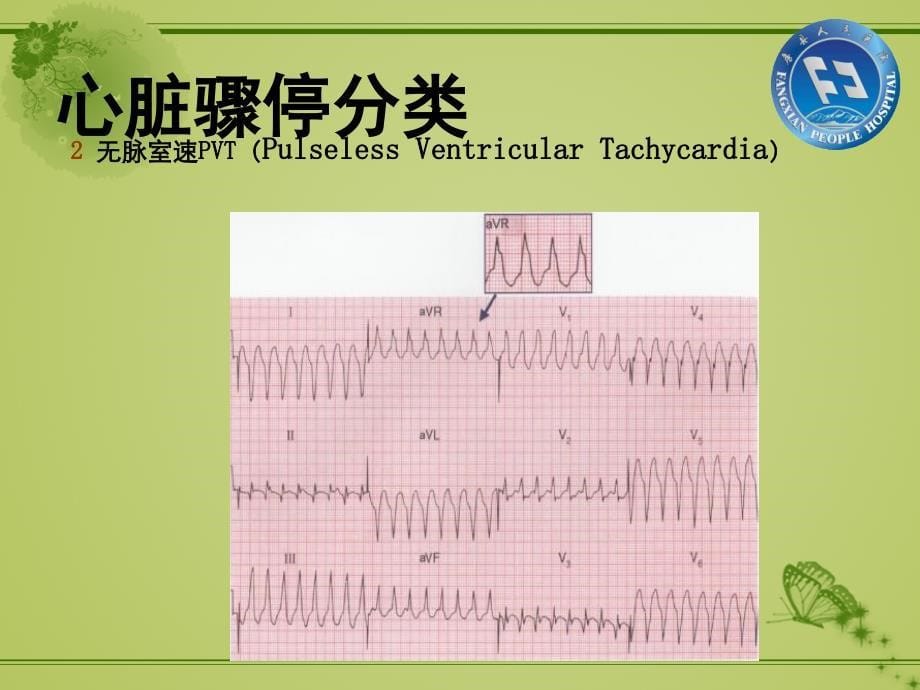 胸痛中心复苏(CPR)_第5页