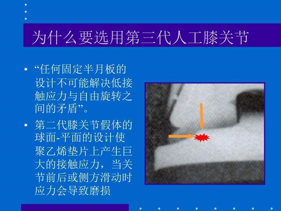 可活动半月板的人工膝关节_第5页