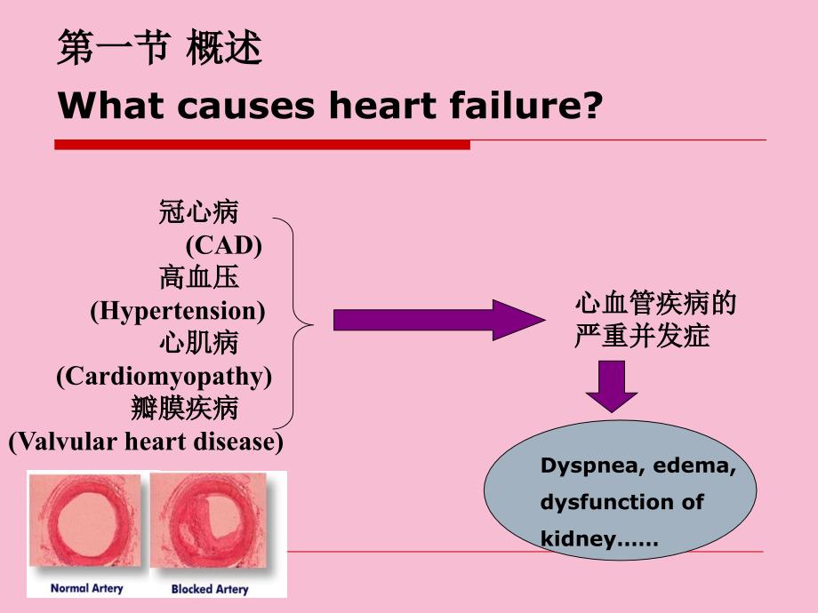 第十四部分心力衰竭heartfailure教学ppt课件_第2页