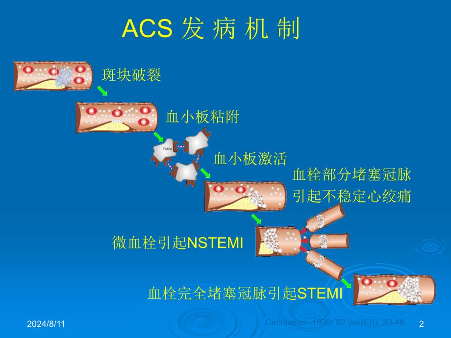 内科学教学课件：急性冠脉综合症的介入治疗_第2页